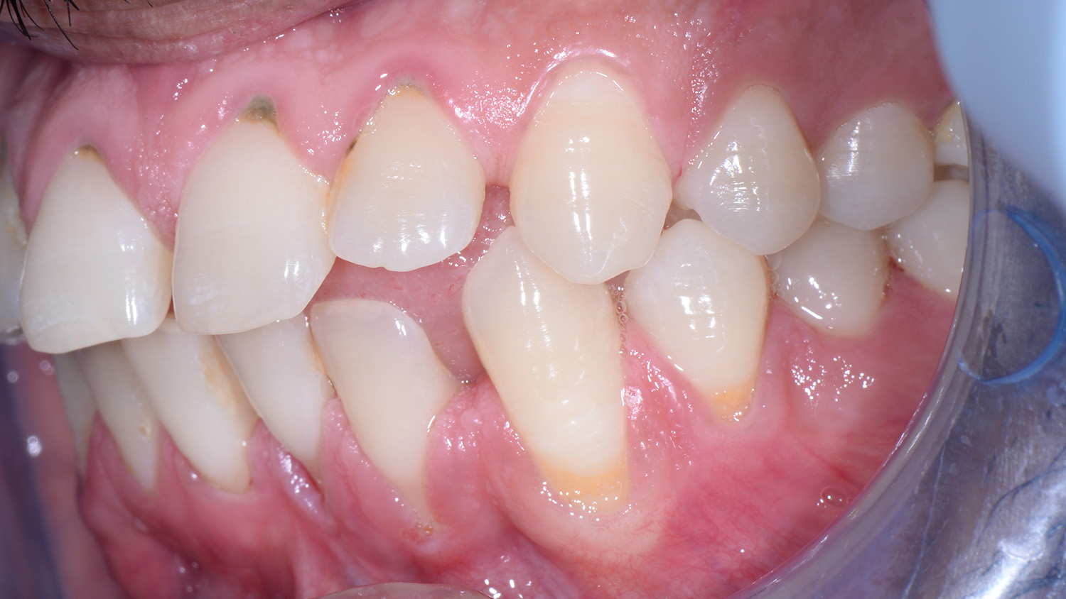 Can Your Loose Tooth Tighten Back Up?